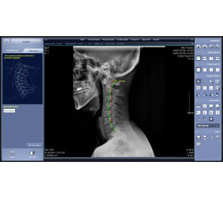 Rayence Xmaru ChiroView Imaging Software